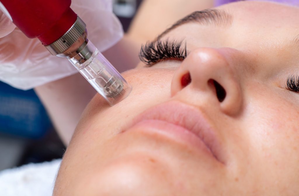 Showing an up-close view of the process of microneedling for the skin