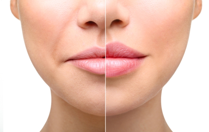 A before and after comparison of dermal fillers, showcasing plump, fuller lips