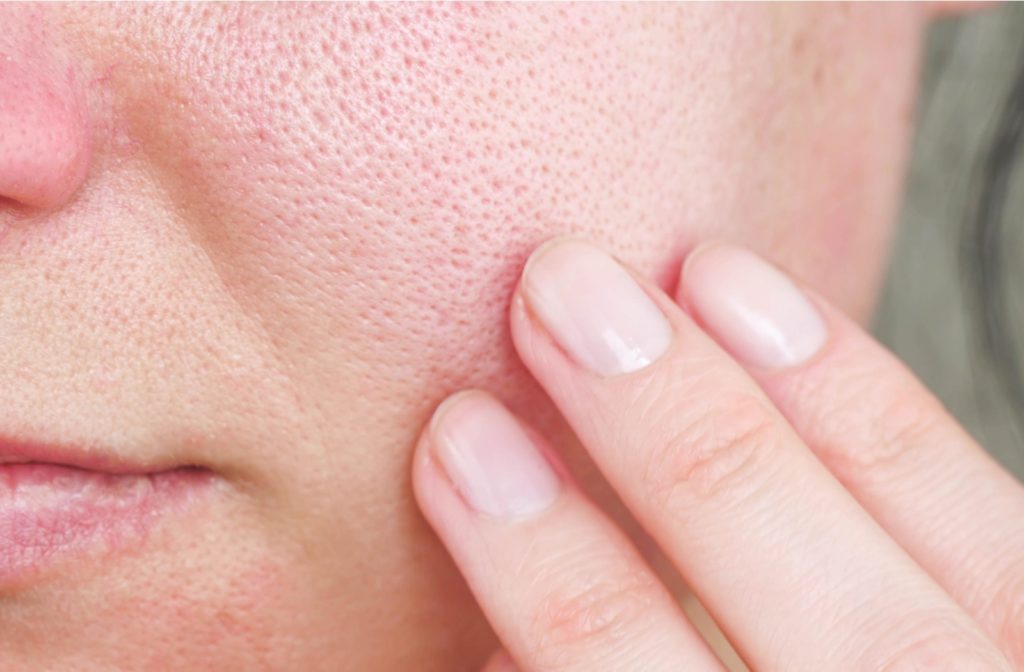 A close up of a woman's textured skin on her cheek, showing her enlarged pores