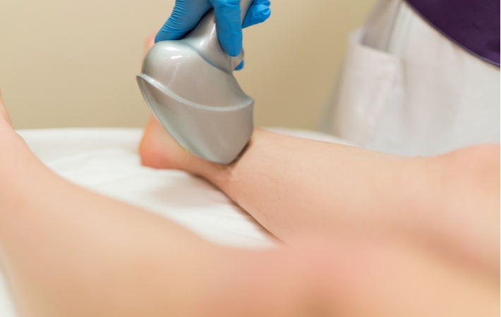 A person laying down receiving an endovenous laser treatment to help treat spider veins on their legs