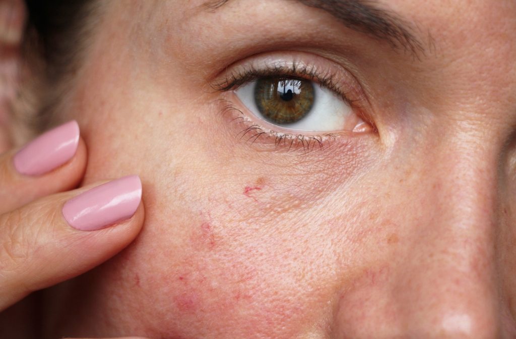 A close up of a woman's face showing the spider veins that she sufferers from