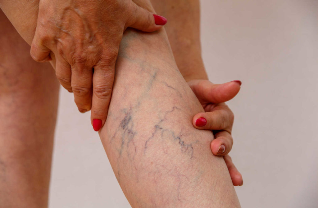 A close up of a woman's leg showing spider veins.