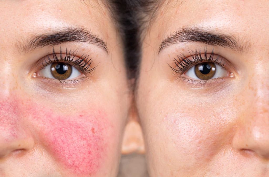 A before and after of a woman's cheek after a laser treatment for rosacea