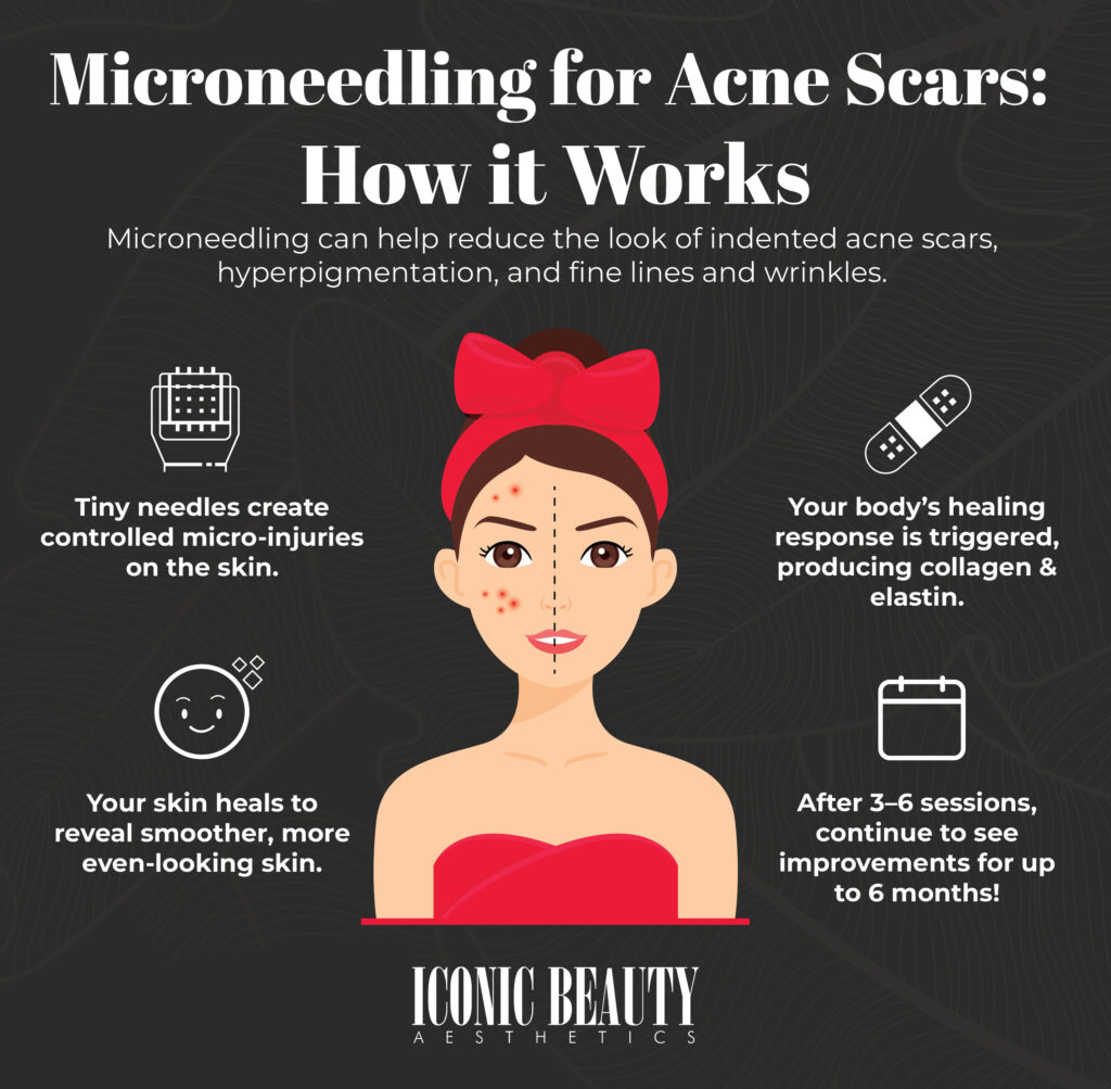 An infographic explaining how microneedling for acne scars works including triggering the body's healing response to trigger collagen production.