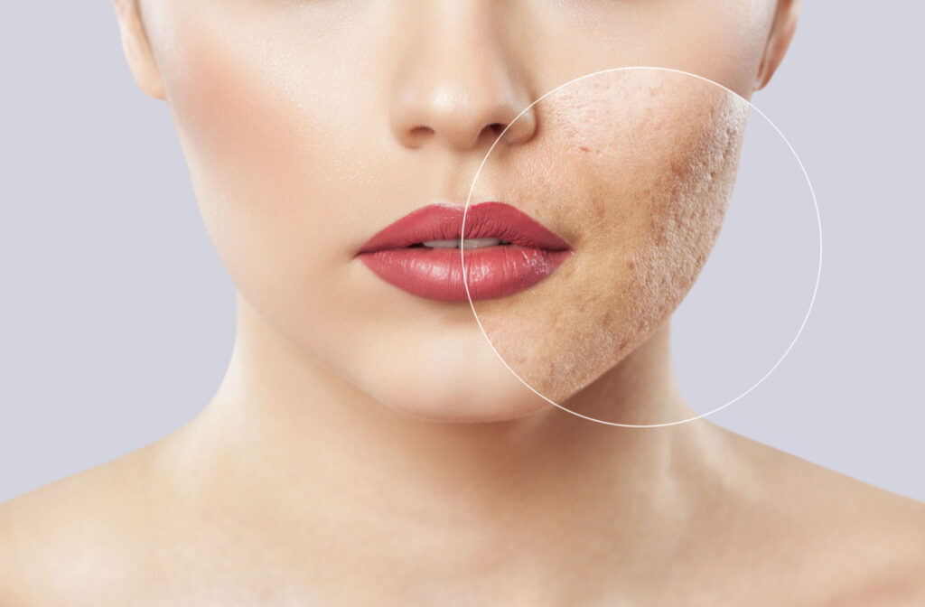 A close up of a woman's face with a circle on the right side magnifying the appearance of acne scars.