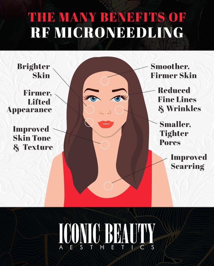 An infographic displaying the benefits of RF microneedling, including brighter skin, reduced fine lines and wrinkles, smaller pores, and improved skin tone.