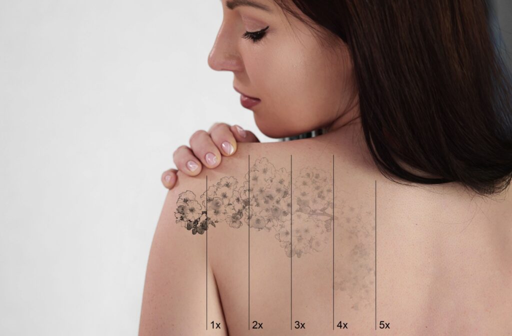 A young adult looks over their shoulder at a floral tattoo on their left shoulder, showing 5 increments of laser removal.