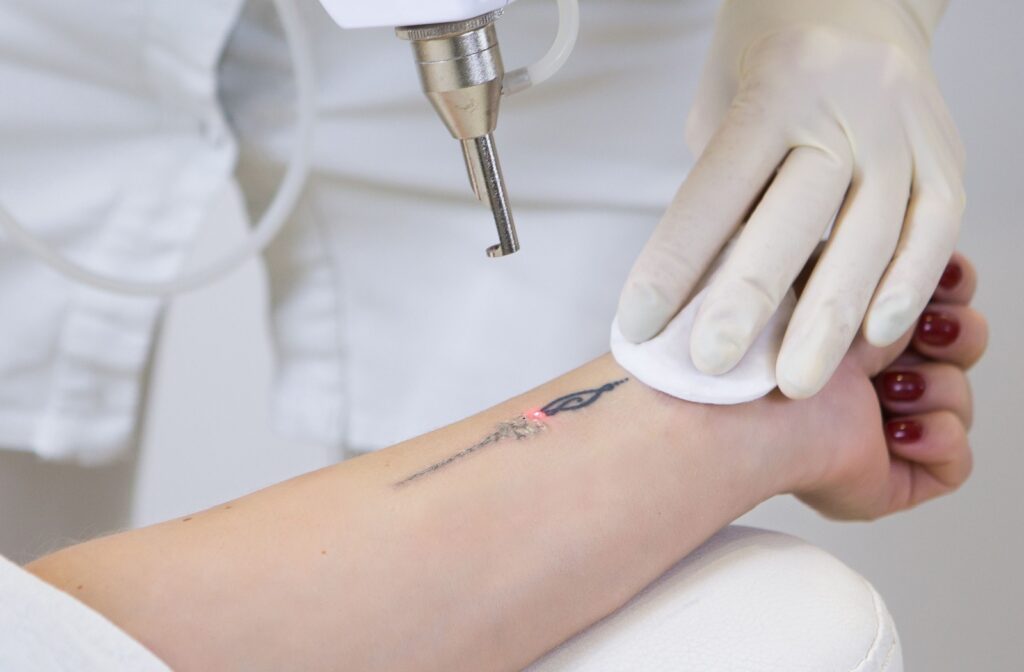 A laser device positioned above a patient’s arm, about halfway through applying a treatment to a small forearm tattoo.