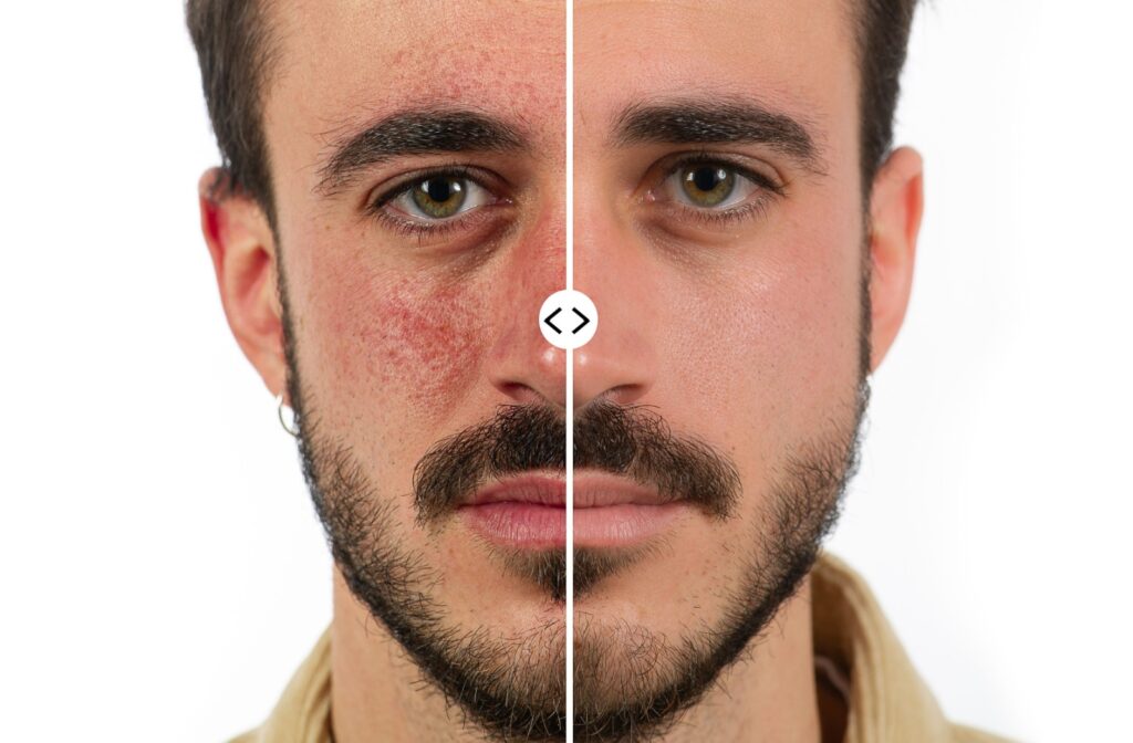 A close-up image of an adult's face that demonstrates being affected and unaffected by rosacea symptoms.