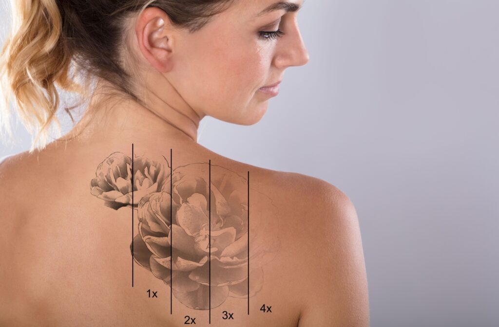An image showing 5 different stages of tattoo removal on a model's back.