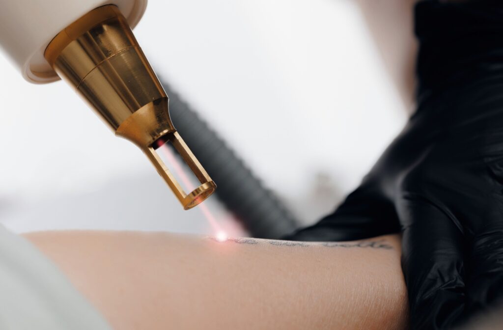 A close-up image of laser tattoo removal on a patient's wrist.